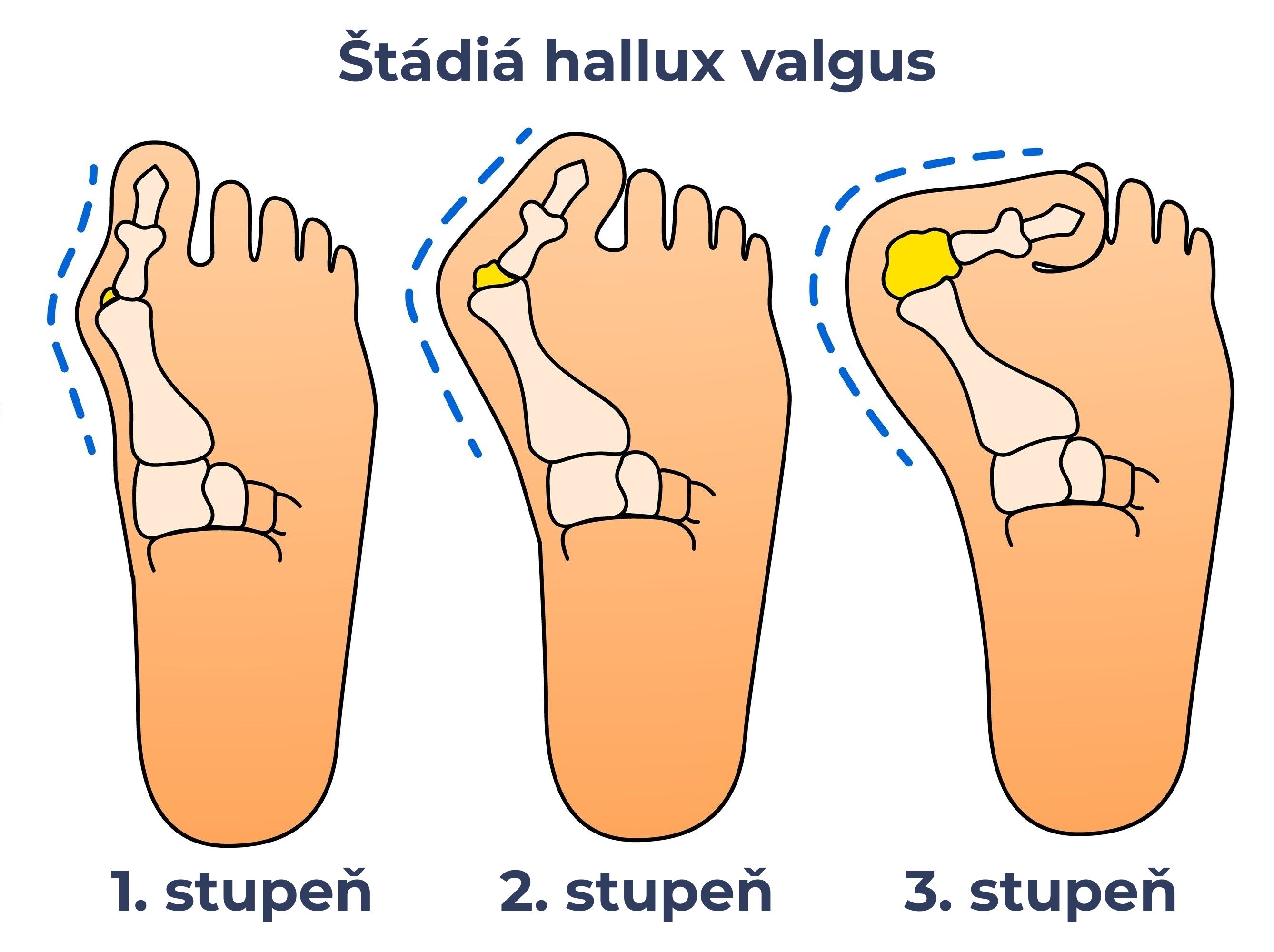 Štádiá hallux valgus a progresia deformity vbočeného palca